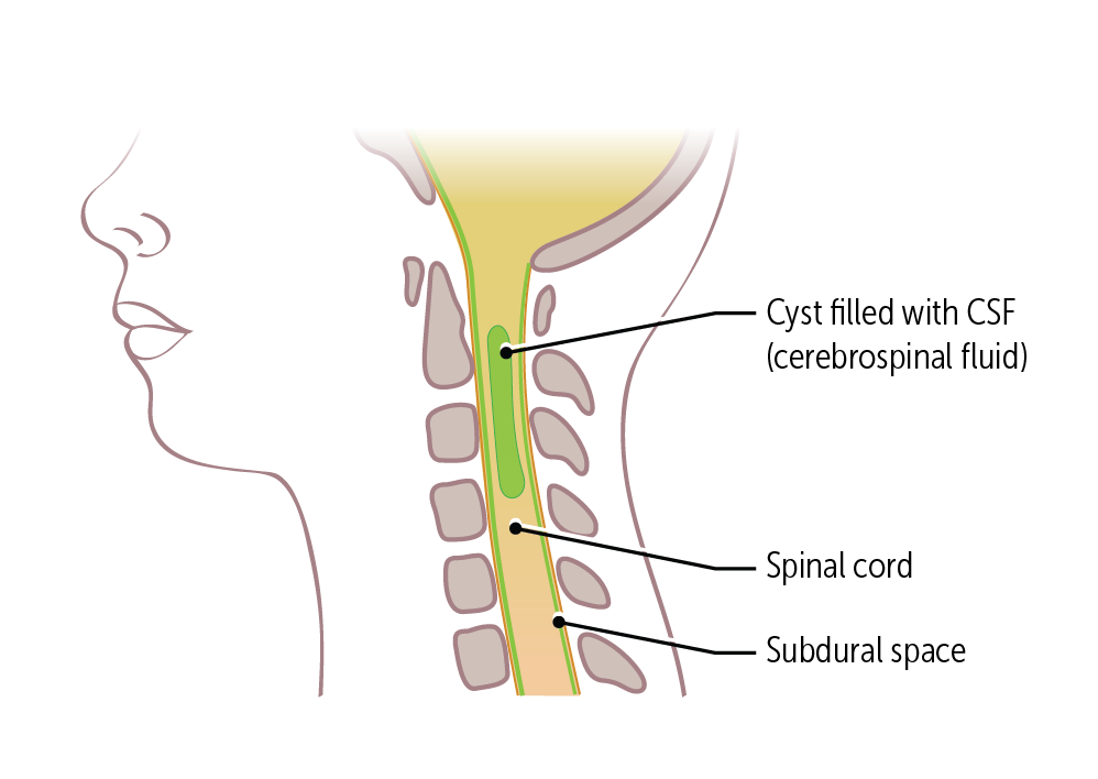 Syringomyelia Cape Like